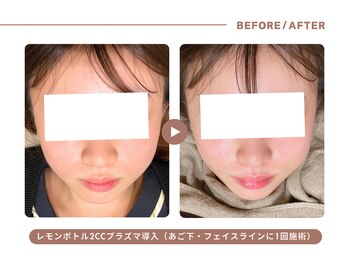 イエス マイサロン(yes My Salon)/レモンボトル施術例