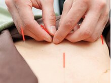 いむき整骨院・いむき鍼灸院/状態に合わせた鍼施術