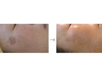 エンヴィー ESTHETIC&SPA ENVYの写真/薄いシミから濃いシミまで根本から改善☆お肌に負担をかけずに、一度の照射でシワも改善しハリもUP！