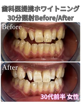 プラチナムビューティ 四条烏丸店(PLATINUM Beauty)/ホワイトニング!Before./After!