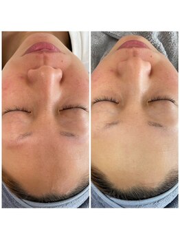 サロンピュア 所沢店/光フェイシャルモニター様♪