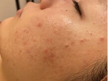 いろは/Reviハーブピーリング