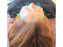 美容鍼初めての方や、男性にも大変ご好評いただいております♪