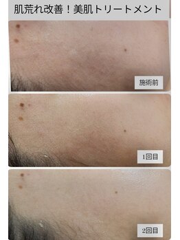 ル クラージュ(Le courage)/バクテリウムピール(20代女性)