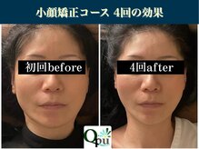 キュープ 表参道店(Qpu)/たった4回でここまで変わります