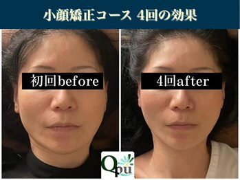 キュープ 表参道店(Qpu)/たった4回でここまで変わります