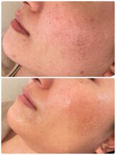 ニコリ(Nicori)/徹底美白