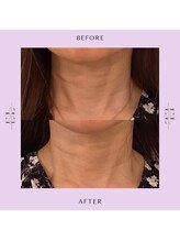 レミュ(Les mieux)/エクソリフト