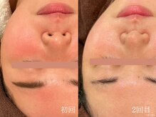 ウォーム(warm)/肌質改善/岡山/フェイシャル