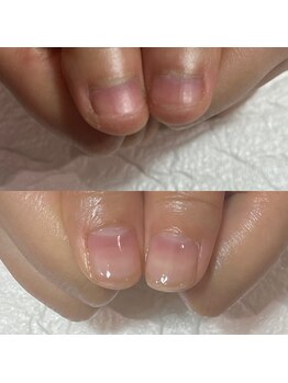セラキュアネイル(Theracure nail)/2回目の施術で深爪解消
