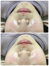 メイユール(MEILLEUR)/光フェイシャル1回