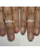 マニュコクーン(ManuCocoon)/爪育成　深爪　巻き爪　大阪市