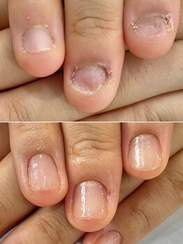 リファーレ(RIFARE)/【深爪矯正】健康的なお爪に◎