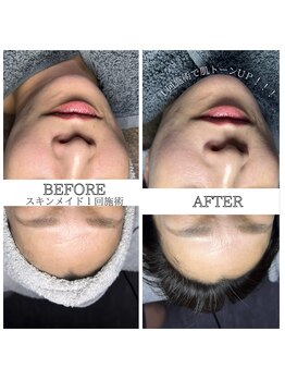 カルナ(CARNA)/スキンメイド１回施術施術前後