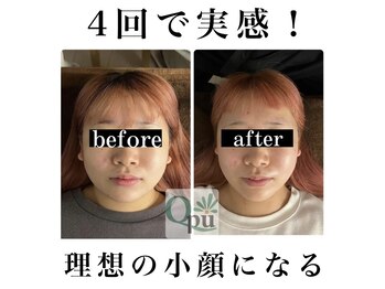 キュープ 相模原淵野辺店(Qpu)/たった4回で人生で1番小さな顔に