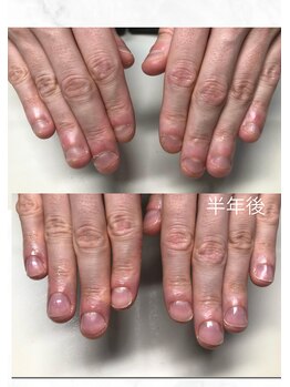 ティアラネイル 宇都宮/深爪矯正