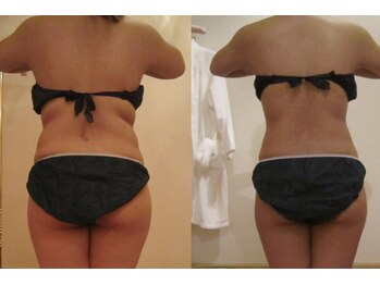 れふぇるん 足利店/ブライダル引き締めボディ 12回