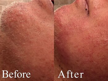 オハナ(Ohana)/メンズヒゲ美容電気脱毛60分