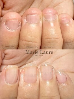 マリーロール 梅田店(Marie Laure)/自爪育成/深爪矯正/ネイルケア