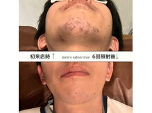 トゥルー(true)の雰囲気（カミソリ負けで荒れていたお肌もヒゲ剃りが減り肌荒れ改善☆）