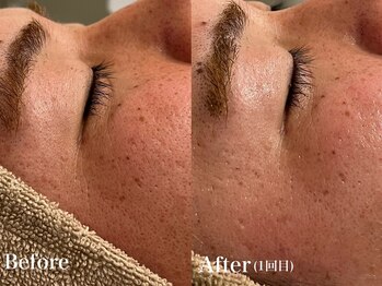 シャルム(Charme)/メンズフェイシャル♪毛穴ケア