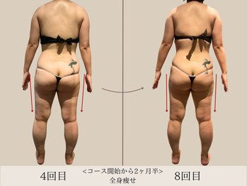 エル 麻布十番(LllL)/【痩身】2ヶ月半ビフォアフ