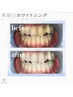 セルフホワイトニング★歯を本来の白さへ