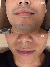 モット いこらもーる泉佐野店(mot)/メンズヒゲ脱毛