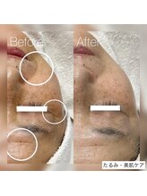 イリス(Iris)/たるみケア＋美肌！