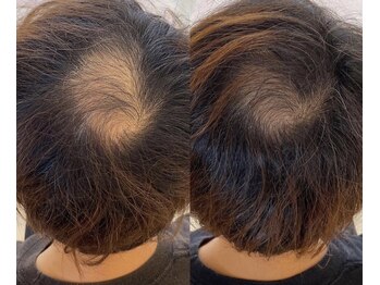 シンデレラ メンズ(Cinderella)の写真/【本気の育毛促進】加齢によるボリュームダウン&ストレスからくる抜け毛…前髪の後退などのお悩みに◎