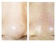 ミヤビ(MIYABI)の写真/気になる頑固な毛穴汚れや黒ずみを徹底ケア◎次世代マシンで叶える深層ケアで、内側から輝く透明感を実感★