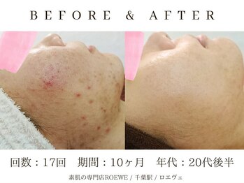 ロエヴェ(ROEWE)/ニキビ改善・毛穴ケア・肌質改善