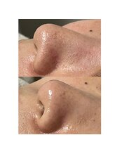 ルアラナ(Lualana)/毛穴の黒ずみ、ざらつきには