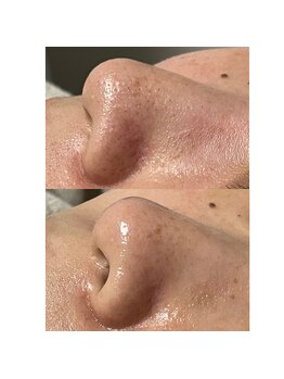 ルアラナ(Lualana)/毛穴の黒ずみ、ざらつきには