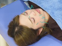 赤沼鍼灸整骨院/リフトアップで小顔に！！！