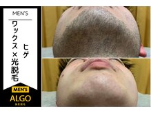 アルゴ 越前店(ALGO)/メンズヒゲ脱毛 before after