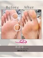 MBS&nbsp;フット角質ケアもお任せください！#フットケア#角質ケア#所沢市