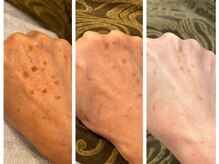 ヨリ(yori)/手のシミケア