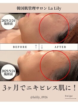 ラリリー(La Lily)/肌質改善!ニキビレスのお肌に!