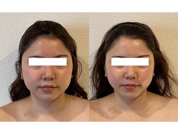 ミベル(MeBell)/小顔矯正/小顔コルギ