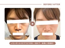 イエス マイサロン(yes My Salon)/レモンボトル施術例