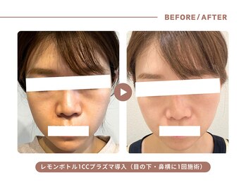 イエス マイサロン(yes My Salon)/レモンボトル施術例