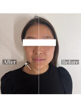 ラナ(Lana)/筋膜小顔リフト