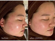アールイーサロン(Re:salon)の雰囲気(【繰り返す肌トラブル】肌悩みに合わせたピーリングをご提案)