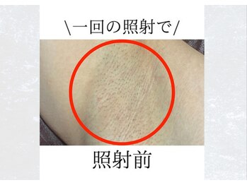 サロンドウルス(salon de ours)/メンズ　ワキ脱毛