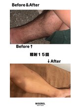 ミセレルオカザキ(MISEREL OKAZAKI)/膝下脱毛