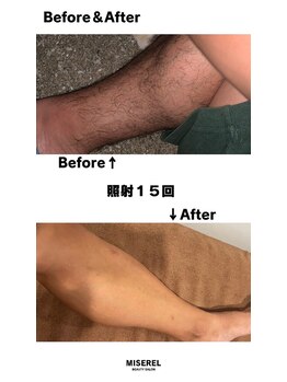 ミセレルオカザキ(MISEREL OKAZAKI)/膝下脱毛