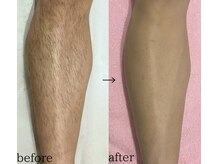 スパイリーア(Spiraea)/脱毛BeforeAfter