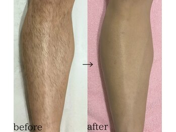 スパイリーア(Spiraea)/脱毛BeforeAfter