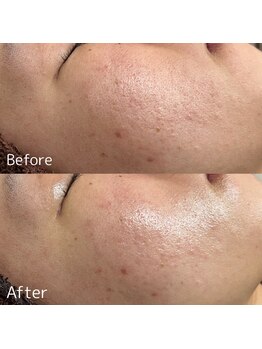 ミノア 大野城店(MINOA)/毛穴洗浄/毛穴の黒ずみ・開き